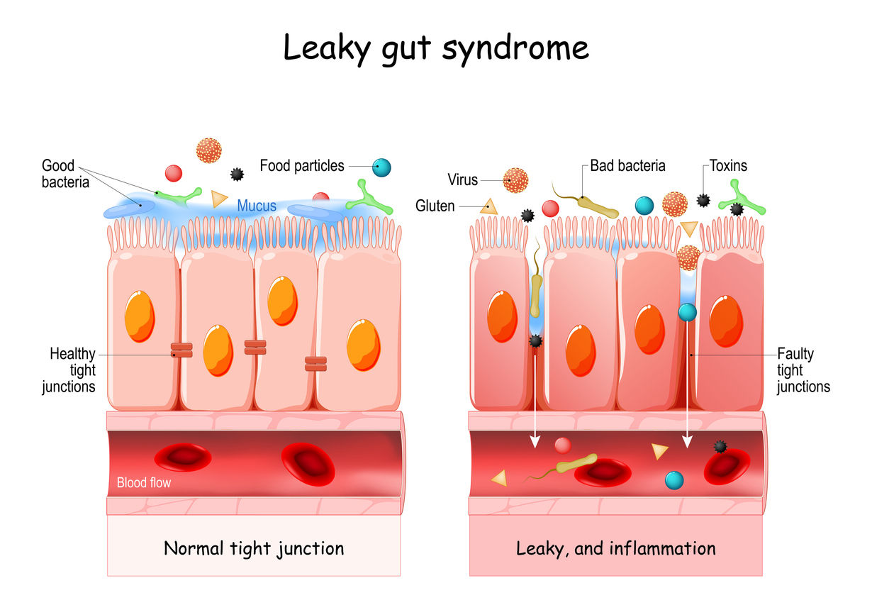 Diagram of common leaky gut symptoms like bloating, fatigue, and digestive discomfort.
